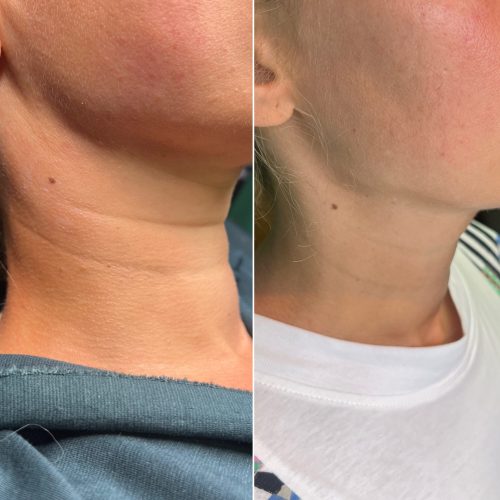 Biostymulacja - iluzaesthetic (15)