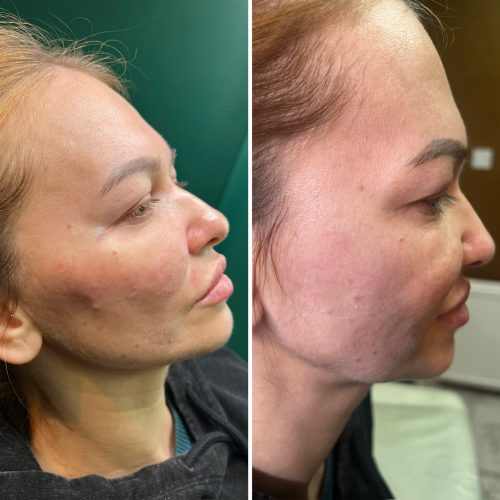 Biostymulacja - iluzaesthetic (18)