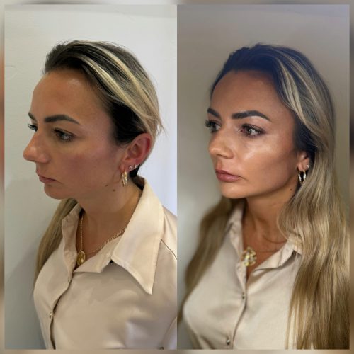 Biostymulacja - iluzaesthetic (3)