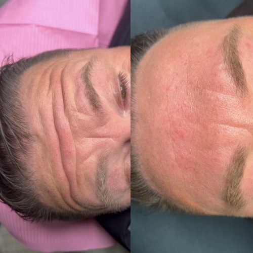 Botox - iluzaesthetic (2)