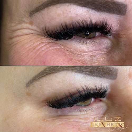 Botox - iluzaesthetic (3)