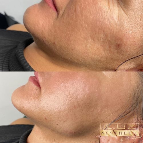 Kwas hialuronowy - iluzaesthetic (1)