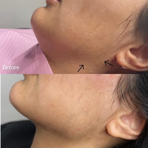 Kwas hialuronowy - iluzaesthetic (11)