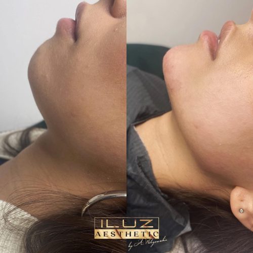 Kwas hialuronowy - iluzaesthetic (2)