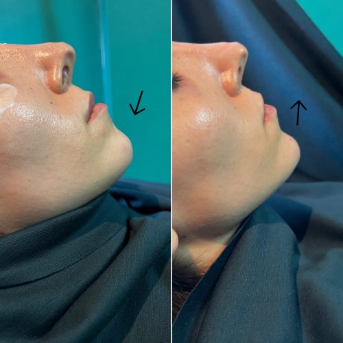 Kwas hialuronowy - iluzaesthetic (3)