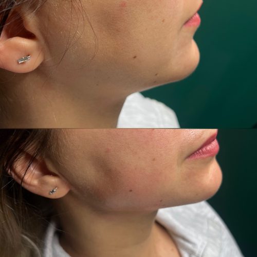 Kwas hialuronowy - iluzaesthetic (4)