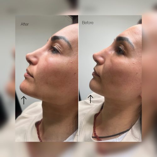 Kwas hialuronowy - iluzaesthetic (5)