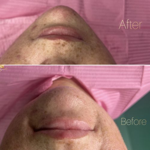 Kwas hialuronowy - iluzaesthetic (7)