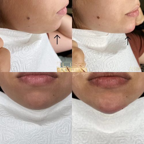 Kwas hialuronowy - iluzaesthetic (9)