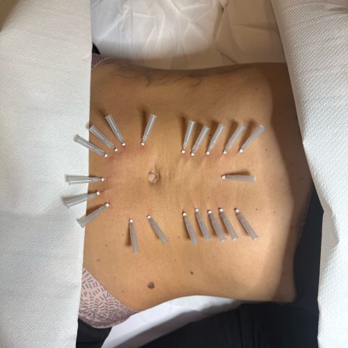 Linéa Lift - iluzaesthetic (1)