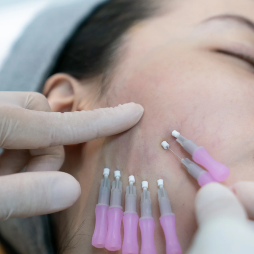 Linéa Lift - iluzaesthetic (1)