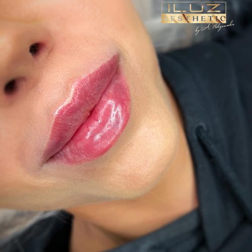 Linea lips - iluzaesthetic (4)