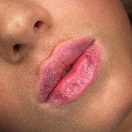 Linea lips - iluzaesthetic (8)