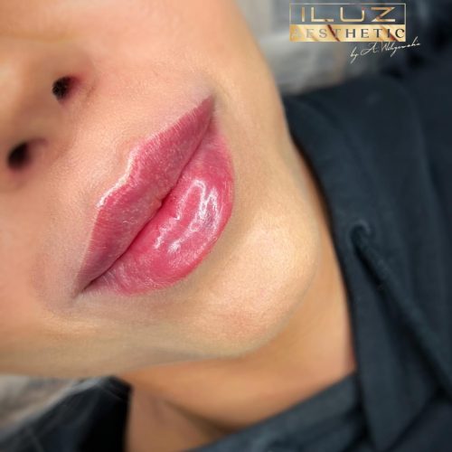 Linea lips - iluzaesthetic (9)