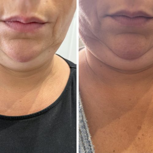 Lipoliza - iluzaesthetic (2)