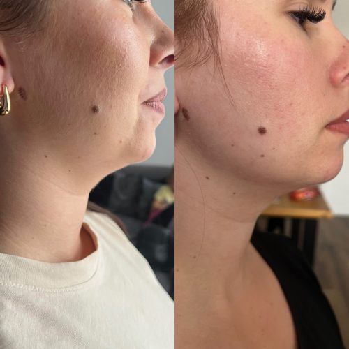 Lipoliza - iluzaesthetic (6)