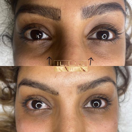 Vita linea eyes - iluzaesthetic (3)