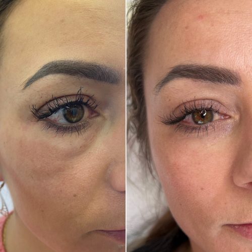 Vita linea eyes - iluzaesthetic (5)