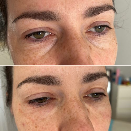 Vita linea eyes - iluzaesthetic (6)